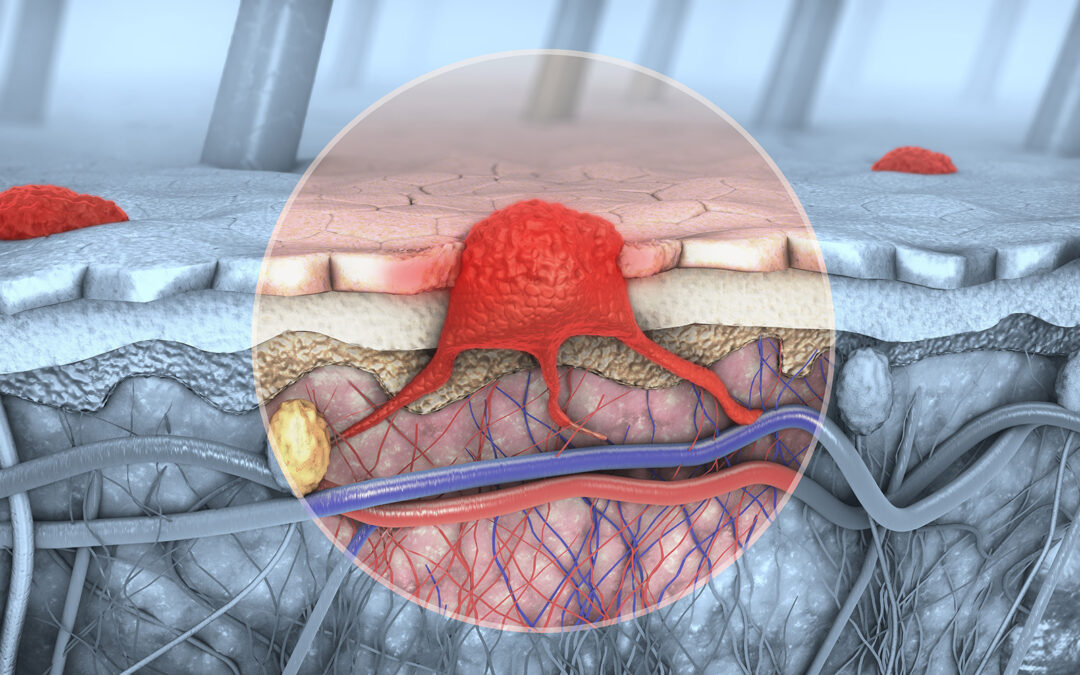 MELANOMA BRAIN METASTASES: CYBERKNIFE RADIOSURGERY APPEARS TO ENHANCE IMMUNOTHERAPY EFFECTS