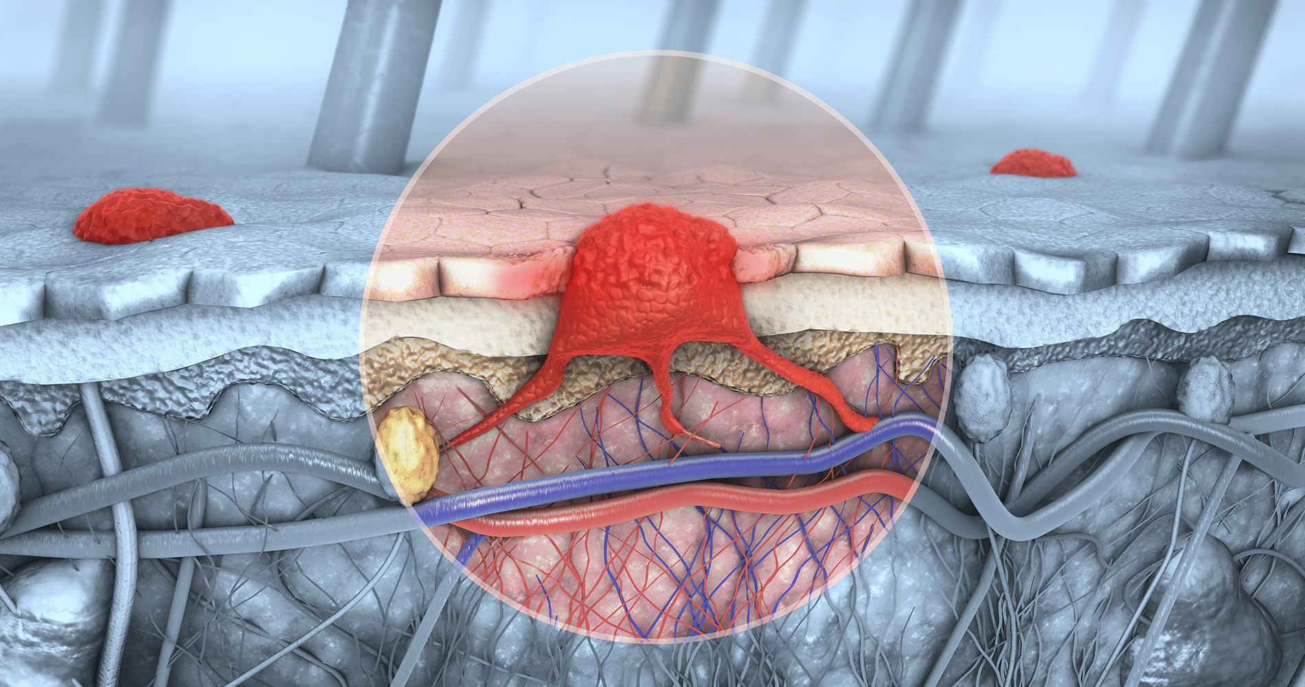 Melanoma Brain Metastases - Radiotherapy for Melanoma - Radiotherapy for Metastases - Options for Metastases