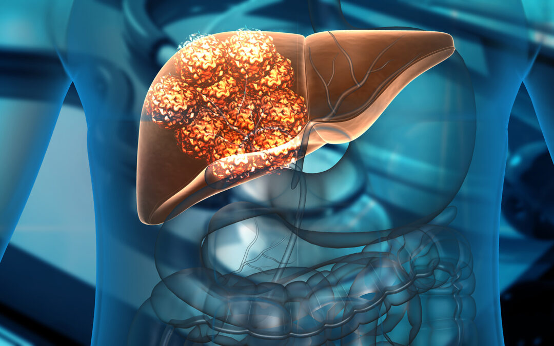 CYBERKNIFE: AN EMERGING TREATMENT OPTION FOR PATIENTS WITH LIVER METASTASIS UNSUITABLE FOR SURGERY