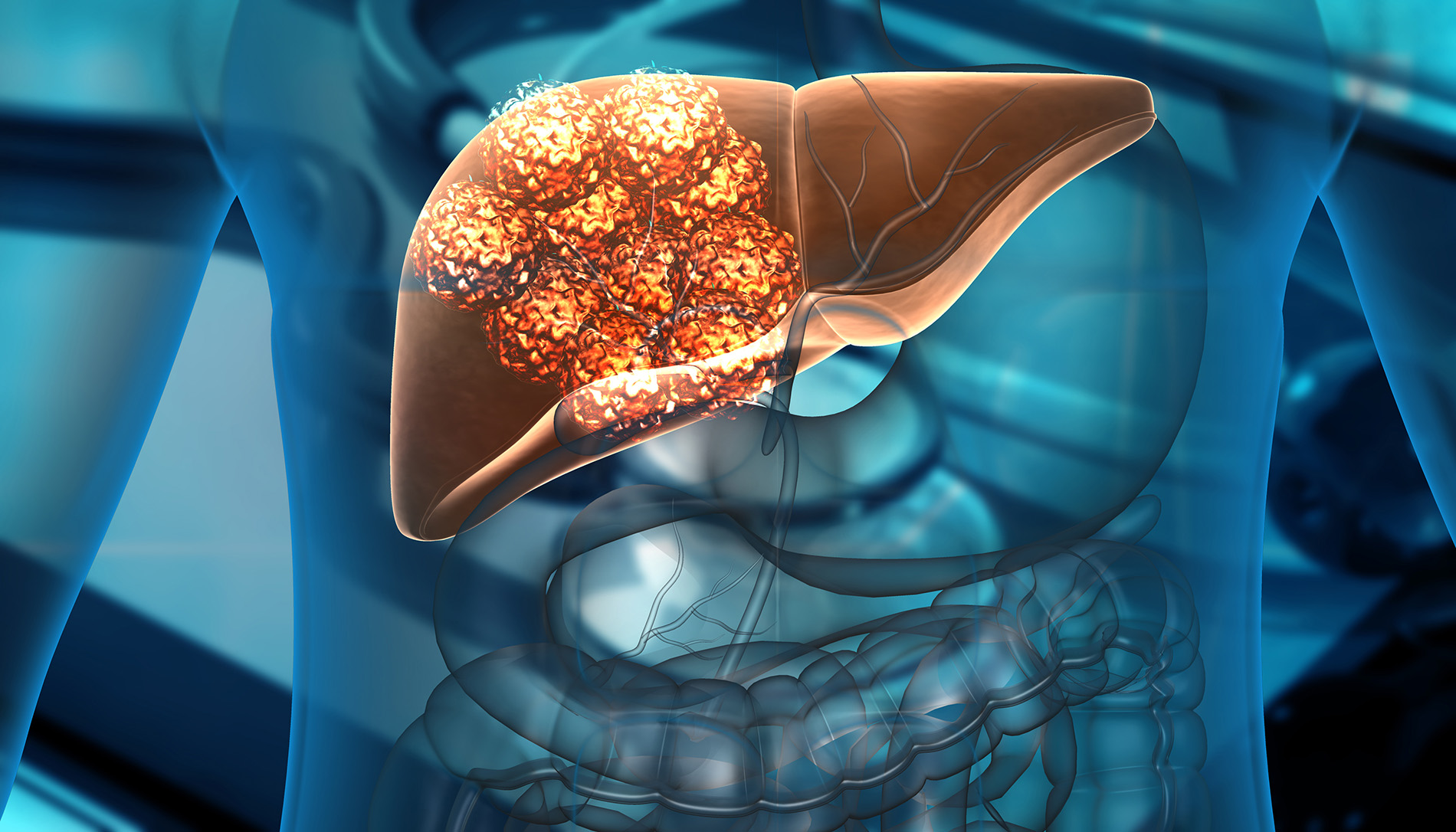 liver metastasis treated with CyberKnife - liver metastasis treatment options - liver metastasis therapy near me