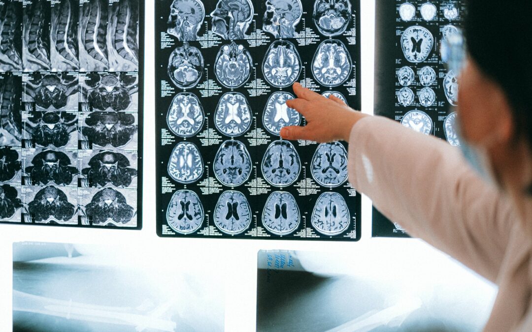 THE DIFFERENT KINDS OF BRAIN TUMORS