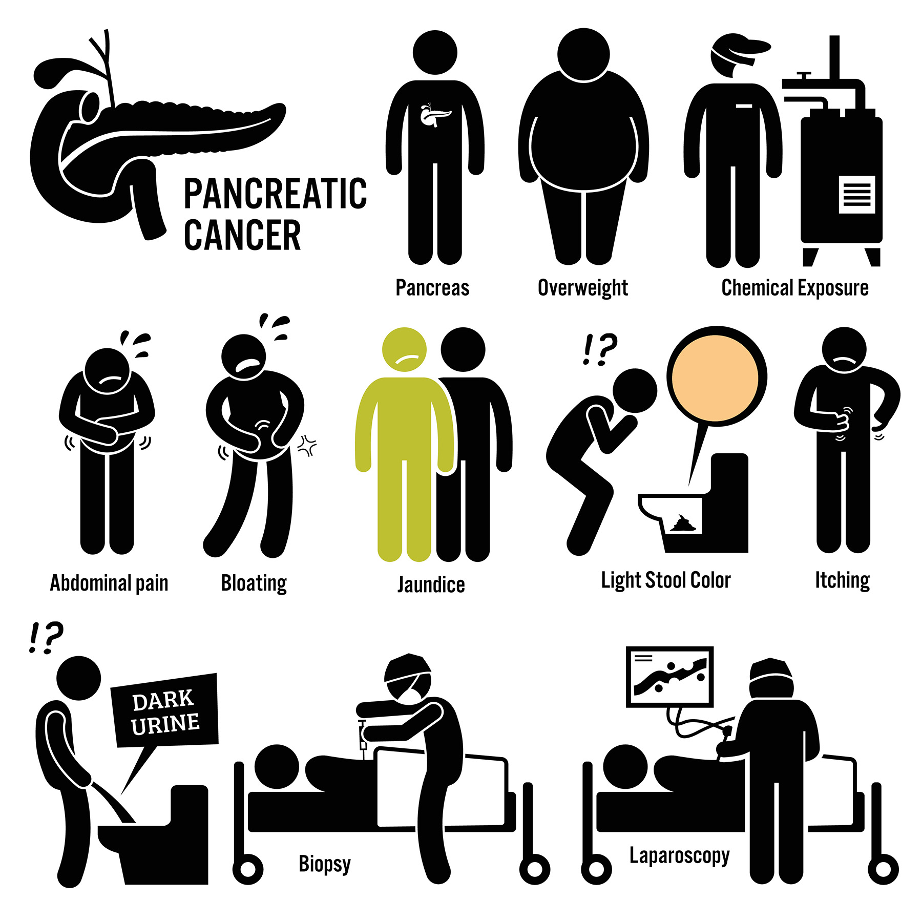 Pancreatic Cancer Symptoms - Pancreatic Cancer Signs - Pancreatic Cancer Diagnosis