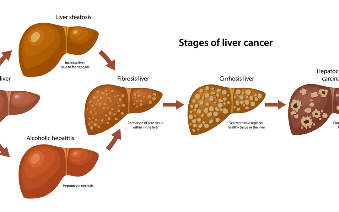 STAGES OF LIVER CANCER