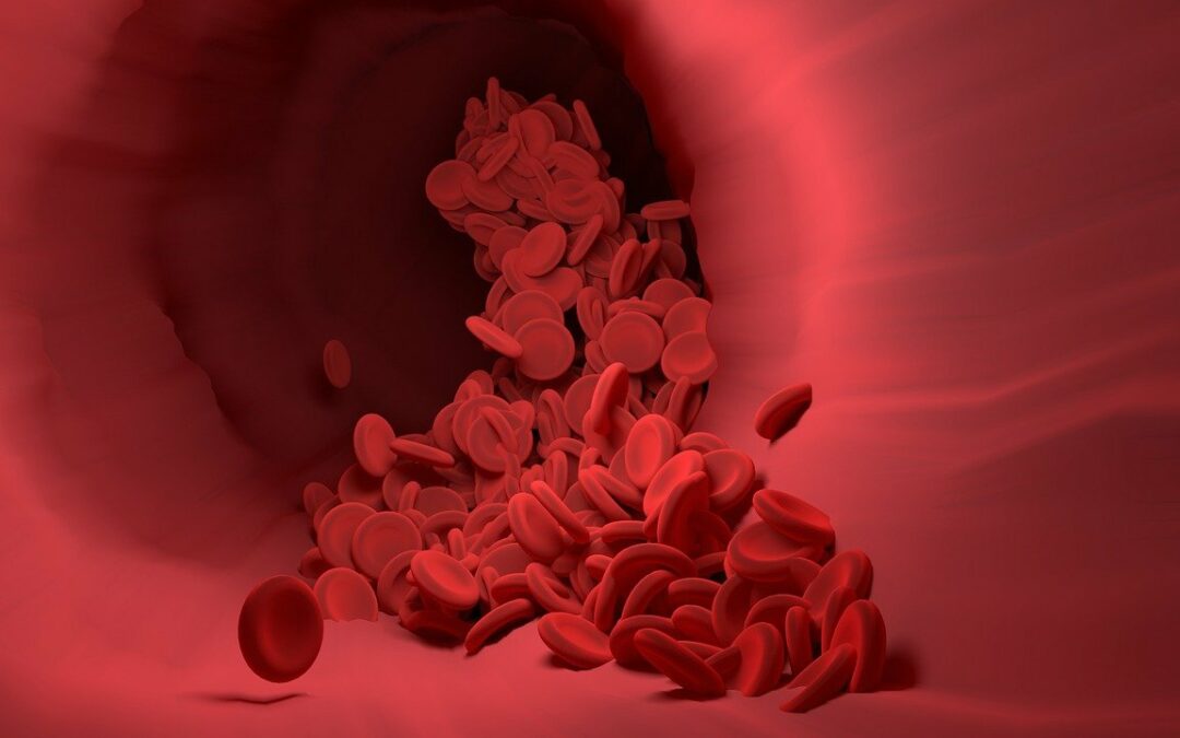 WHAT IS AN ARTERIOVENOUS MALFORMATION (AVM)?