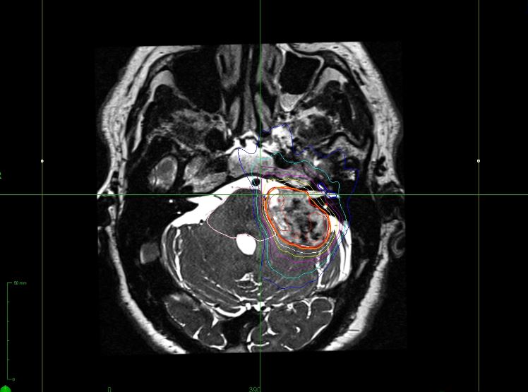 CyberKnife Successfully Treats - Brain Cancer Treatment Center in Miami - CyberKnife Treats Brain Tumors in Miami - Successfully treats Brain Cancer