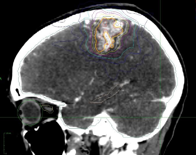 brain and spinal arteriovenous malformation - cyberknife miami - alternative cancer treatment - cancer treatment in south florida