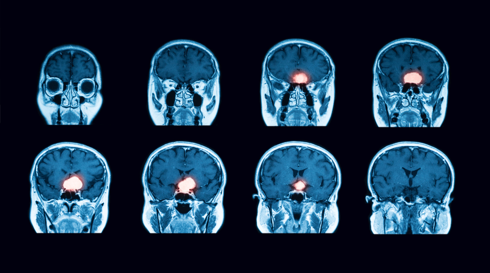 Brain Tumor Imaging - Cancer treatment for brain tumor - brain tumor treatments - radiation therapy for brain tumor