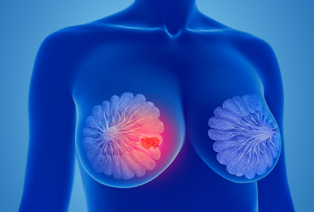 Single-Dose Radiotherapy for Breast Cancer Reduces Damage to Nearby Organs