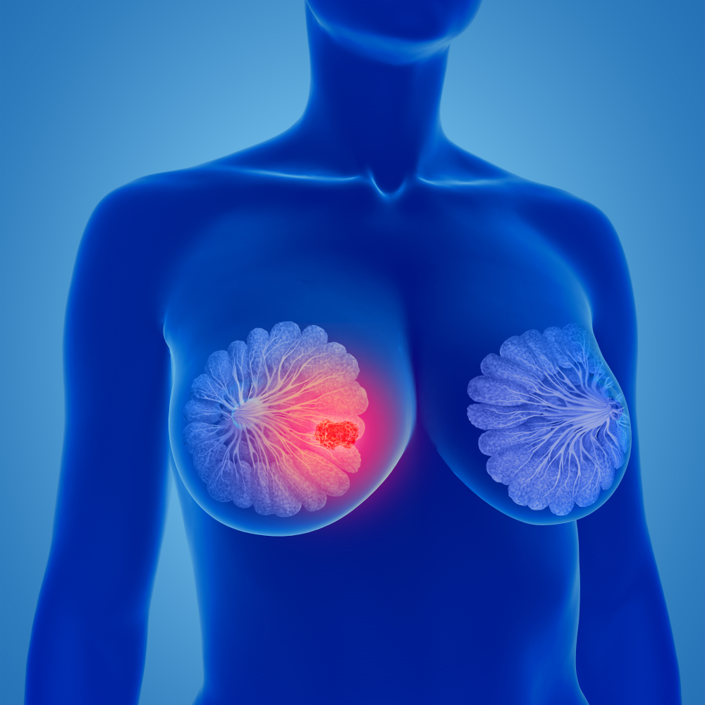 Breast cancer - breast cancer tumor - breast cancer treatment center - breast cancer treatment services near me - alternative breast cancer treatment - metastic breast cancer