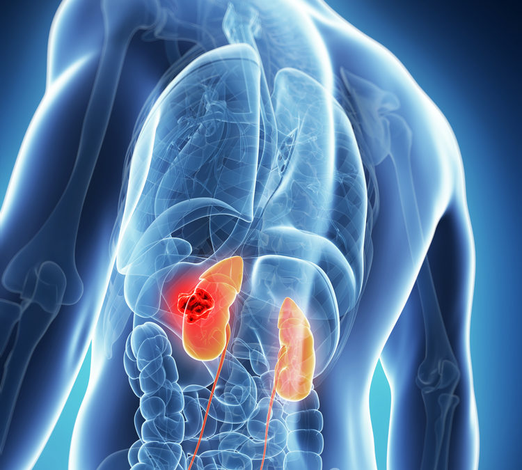 TREATING KIDNEY CANCER: WHAT YOU SHOULD KNOW