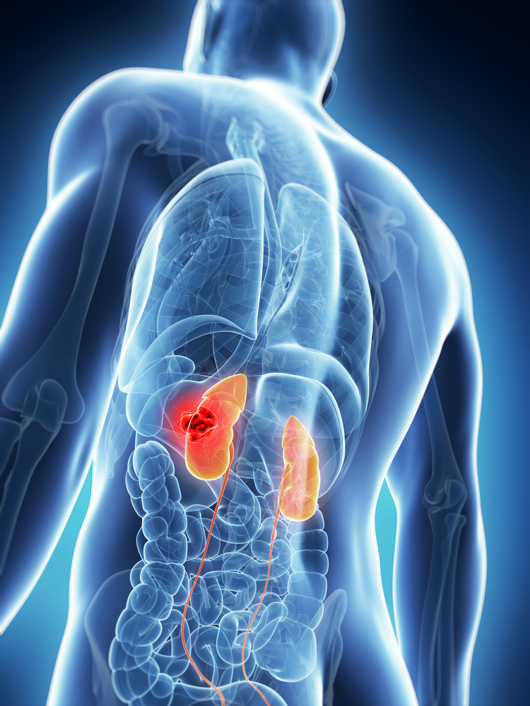 Renal cancer diagnosis - renal cell cancer - renal cell cancer treatment services - kidney cancer treatment with cyberknife