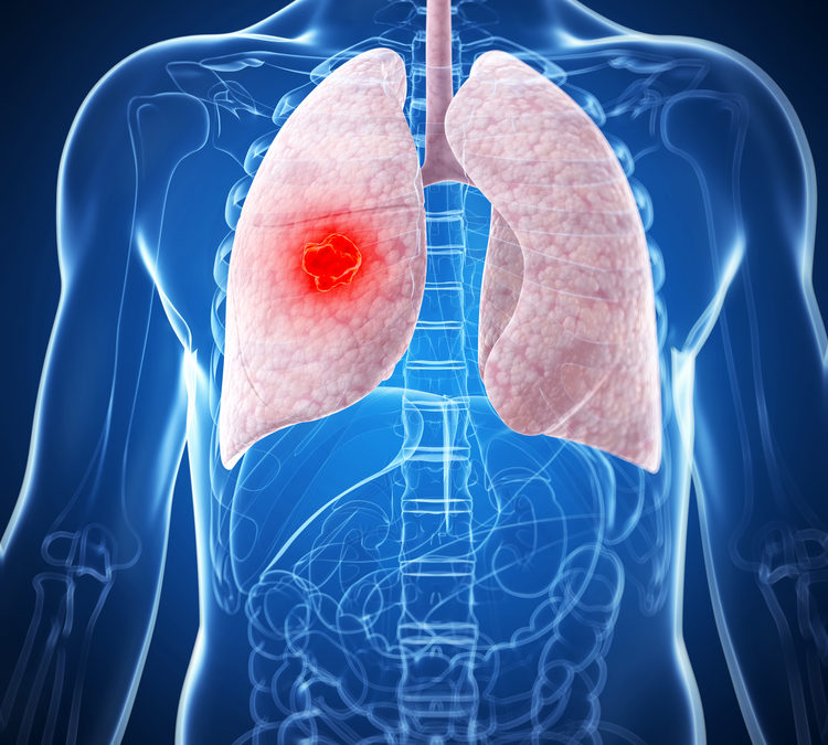NEW STUDY FINDS A CLEAR LINK BETWEEN HEAVY VITAMIN B INTAKE AND LUNG CANCER