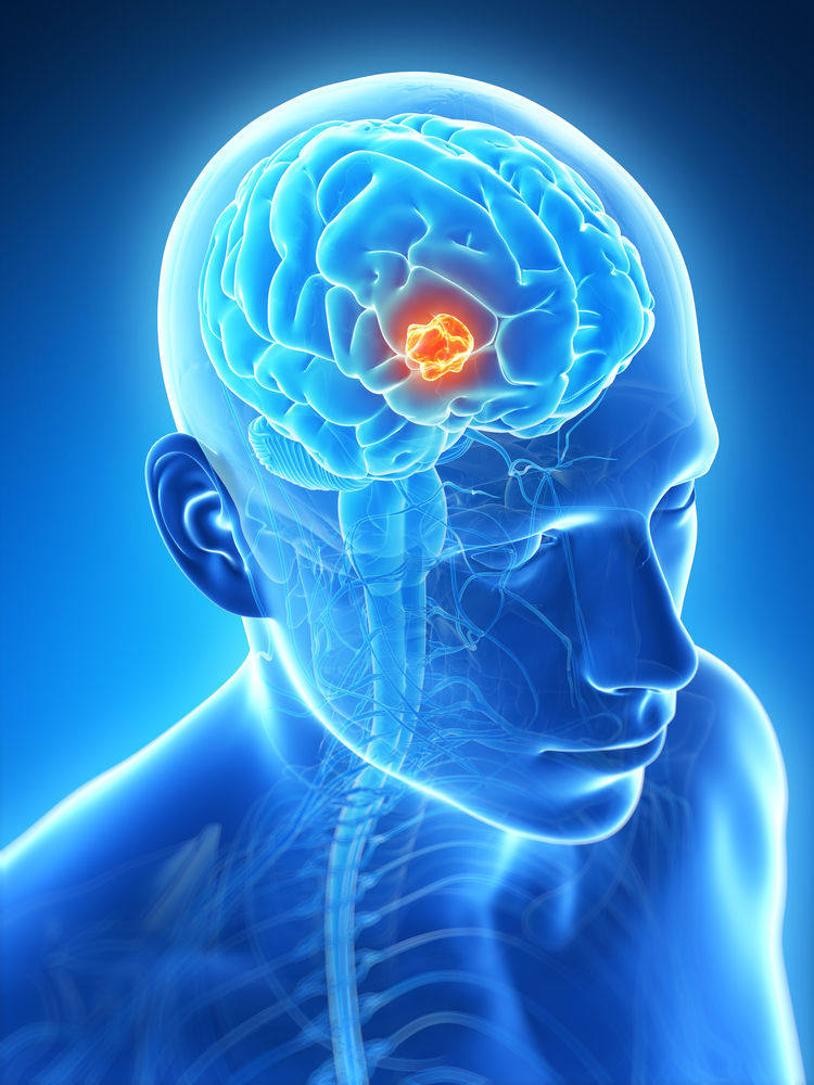 Brain Tumor Survivor - brain tumor - brain cancer - brain cancer treatment alternative - brain cancer surgery alternative - metastatic brain cancer