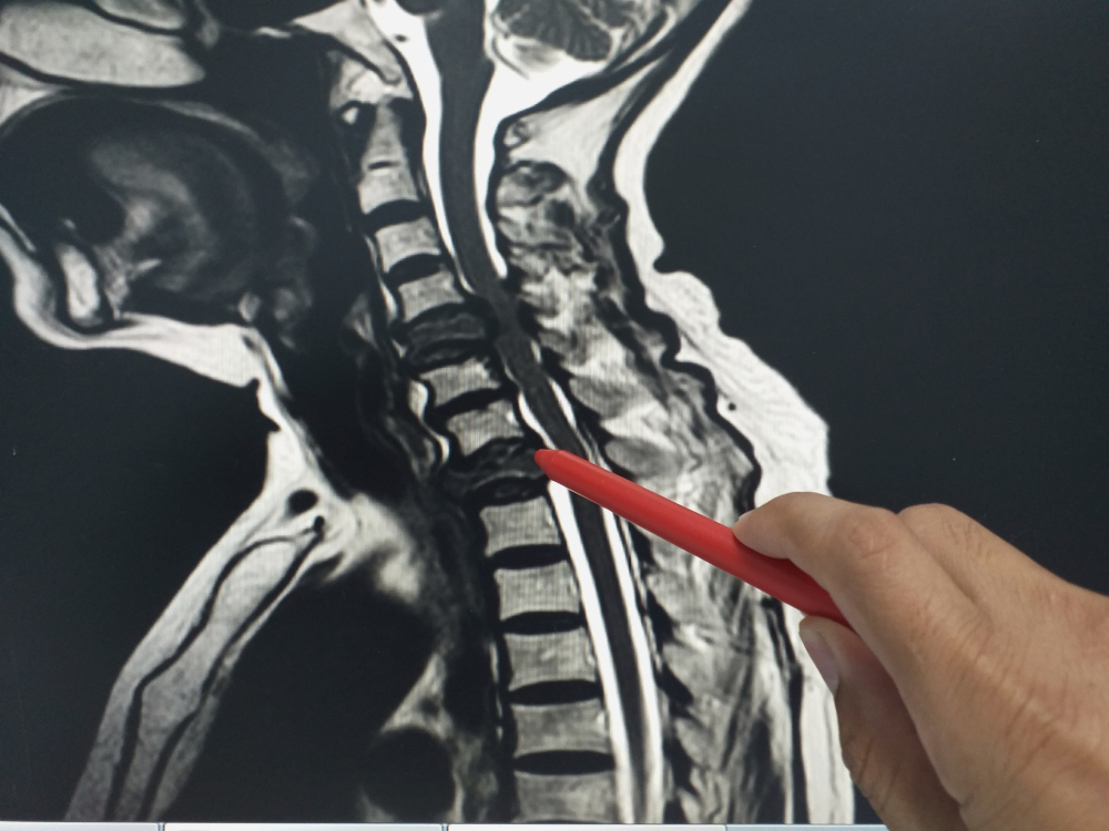 Spinal x-ray cyberknife miami - alternative cancer treatment - cancer treatment in south florida