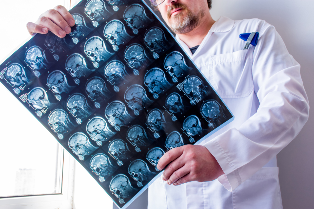 brain scan - brain tumor - brain cancer diagnosis - brain cancer treatment