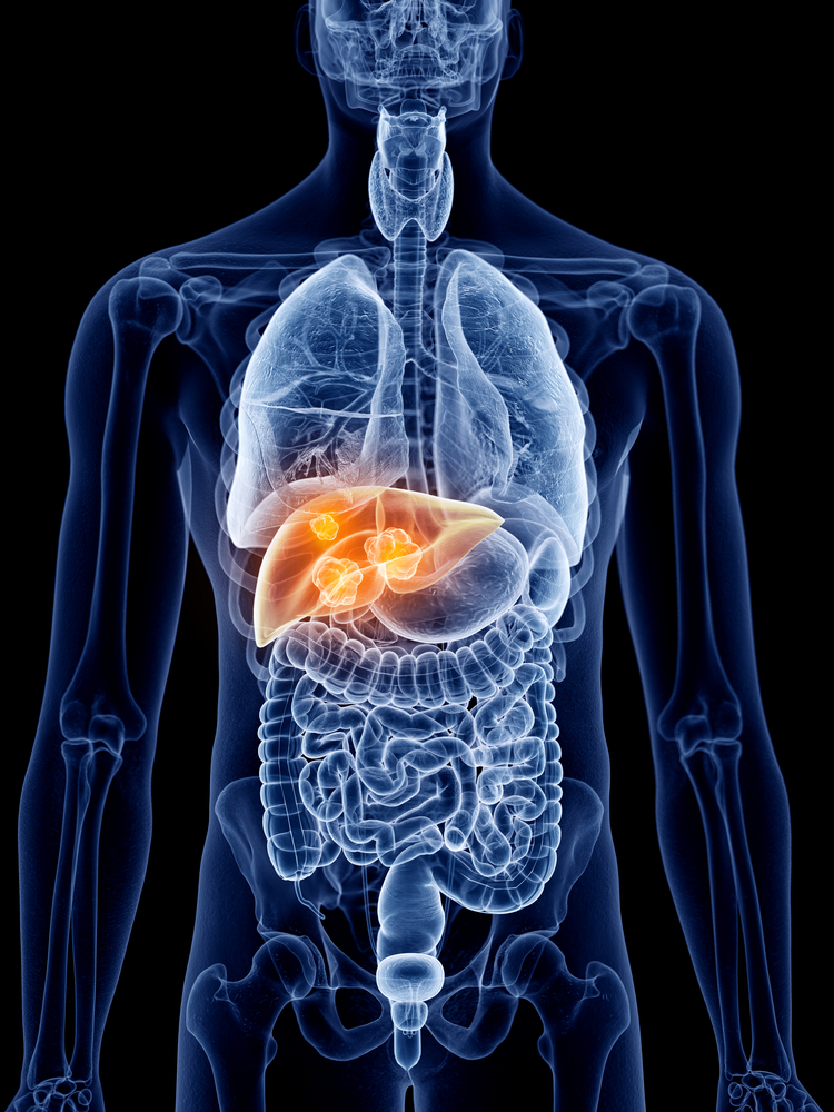 Liver Cancer cyberknife miami - alternative cancer treatment - cancer treatment in south florida