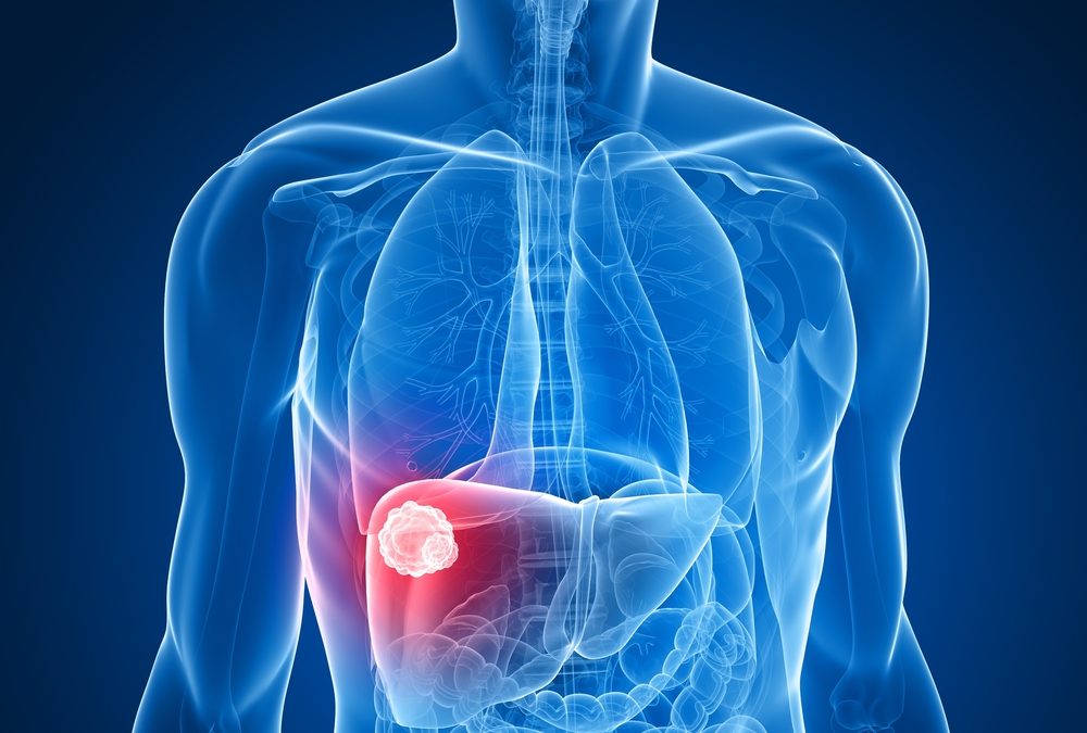 CYBERKNIFE SAFELY & EFFECTIVELY TREATS LIVER CANCER
