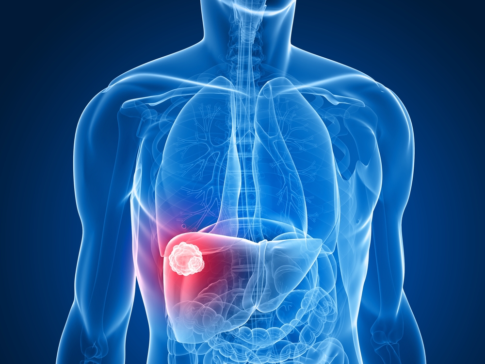 liver tumor - liver cancer - liver cancer diagnosis - liver cancer patients