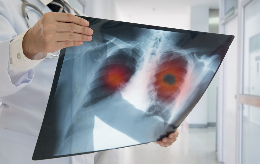 Doctor with lung cancer x-ray cyberknife miami - alternative cancer treatment - cancer treatment in south florida