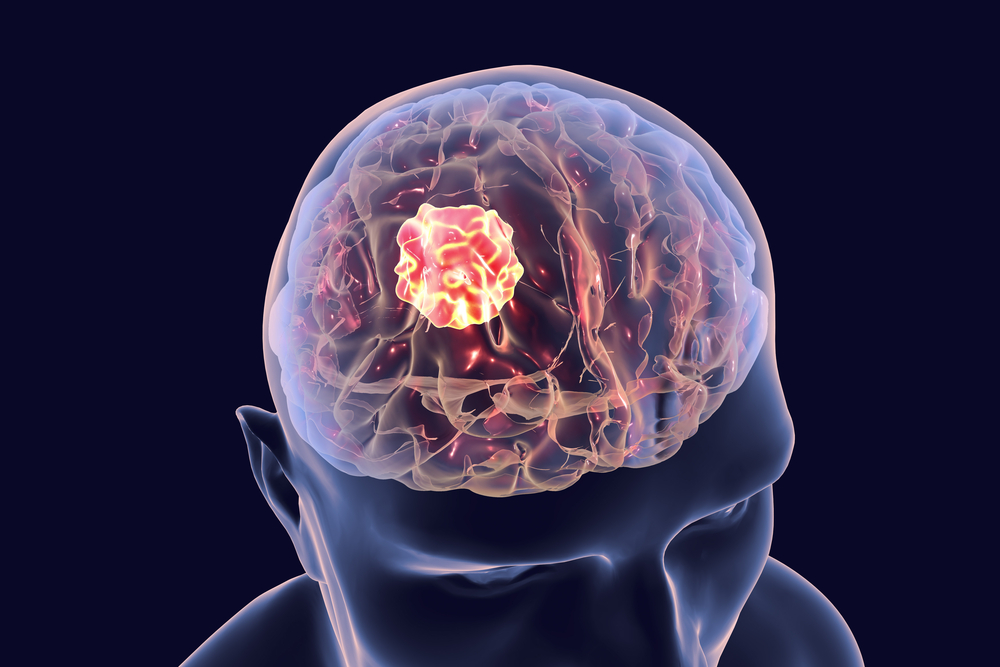 Why I Chose Cyberknife - Brain cancer - brain tumor - cancerous tumors - cancer treatment options for brain cancer - cyberknife brain tumor treatment