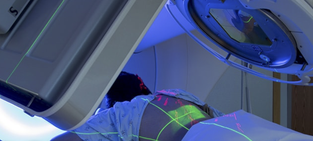 CyberKnife Known as High-Dose SBRT is More Effective for Painful Spine Metastases