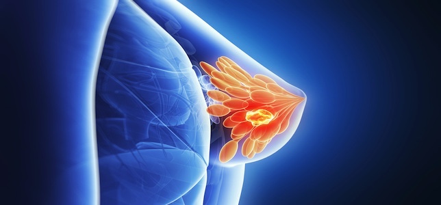 Study Finds Treating Ductal Carcinoma In Situ With Surgery & Radiotherapy Lowers Risk of Developing Breast Cancer Than Surgery Alone