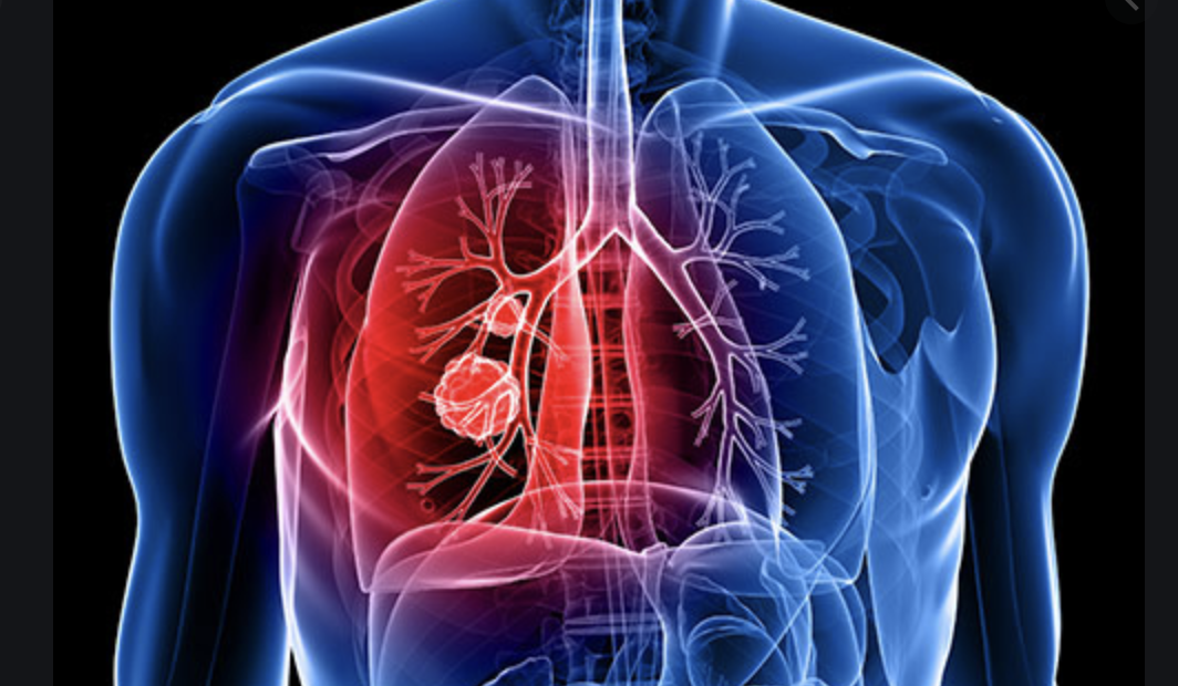 Health Panel Expands Lung Cancer Screening For More Smokers