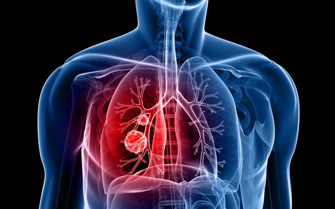 Delaying Lung Cancer Treatment Increases Risk of Death & Recurrence