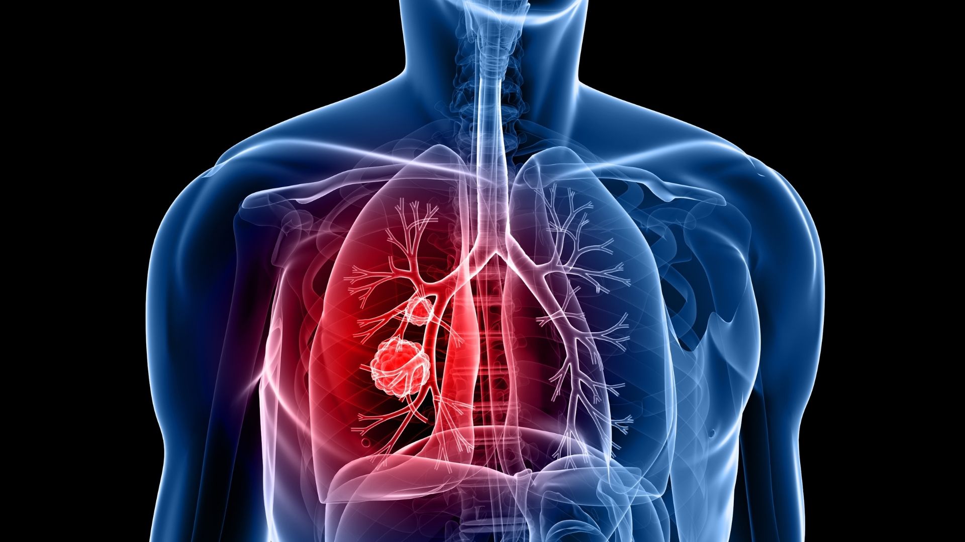 lung cancer - types of lung cancer - alternative cancer treatment miami