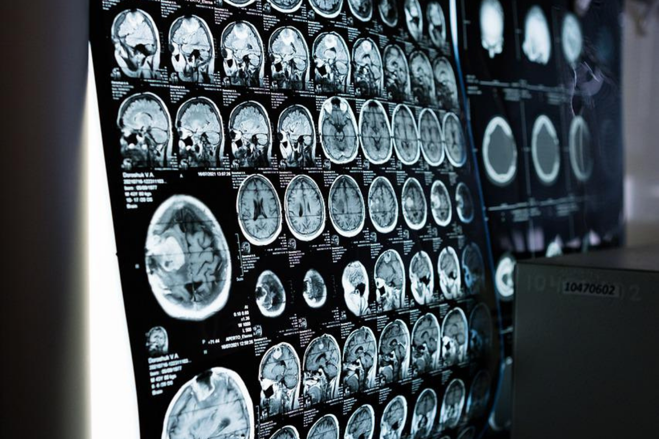 Acoustic Meningioma Treatment