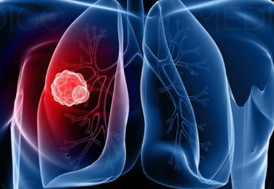 Lung Cancer is Increasing Among Non-Smokers ~ What’s Their Chance of Survival Compared to Smokers & What’s Their Best Treatment Option?