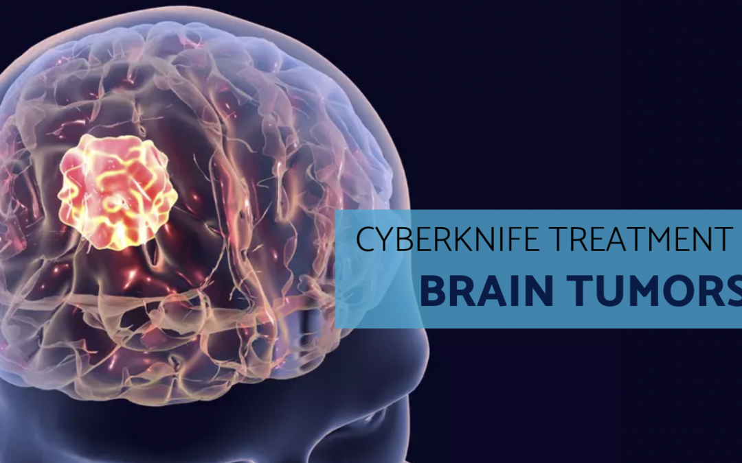 CyberKnife Effectively Treats Brain Tumors Without Surgery