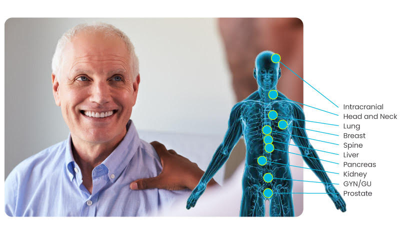 cyberknife miami - alternative cancer treatment - cancer treatment in south florida